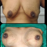 breast-implants-2-scaled