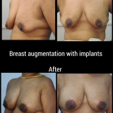 breast-implants-scaled