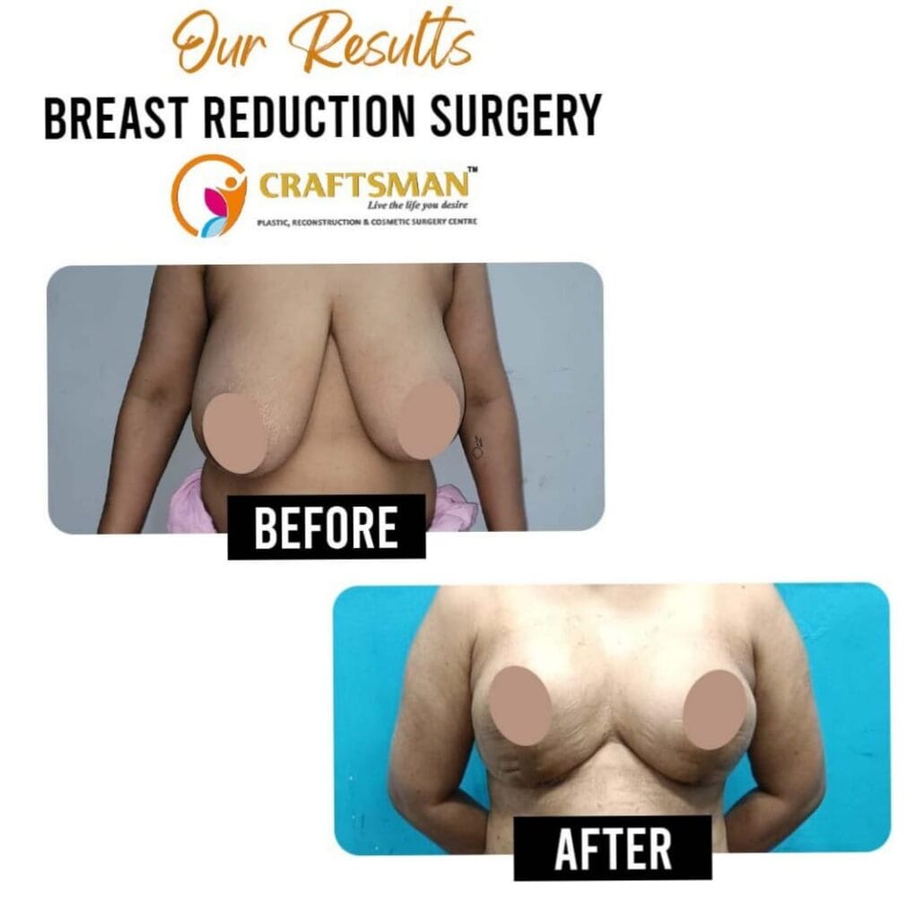 Breast Reduction surgery before & after.