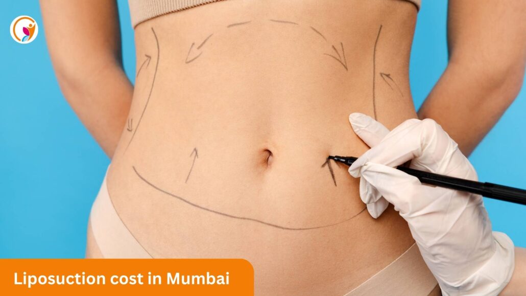 Liposuctioon Cost in mumbai