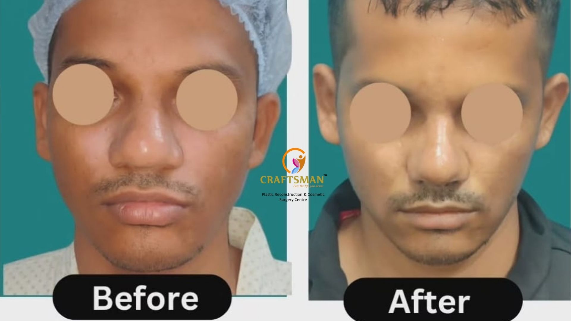 Broad Nose Rhinoplasty