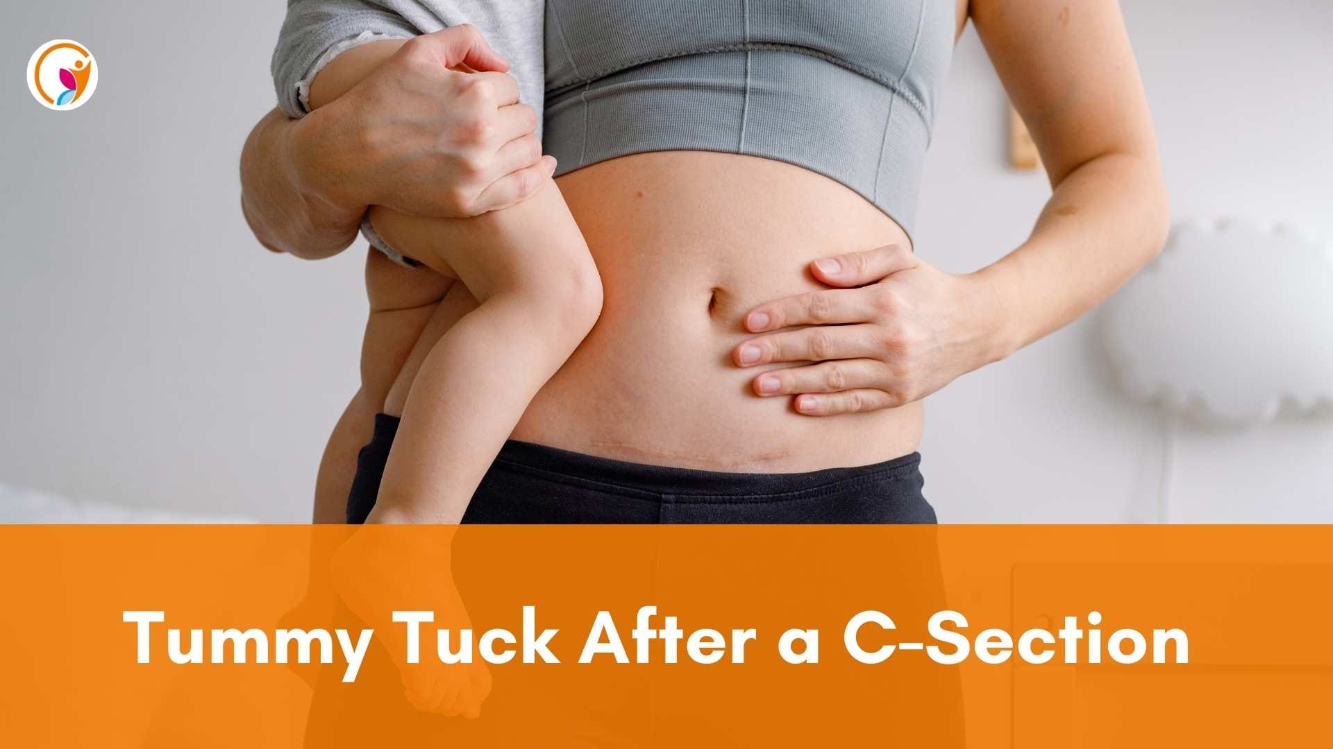 Tummy Tuck After a C-Section