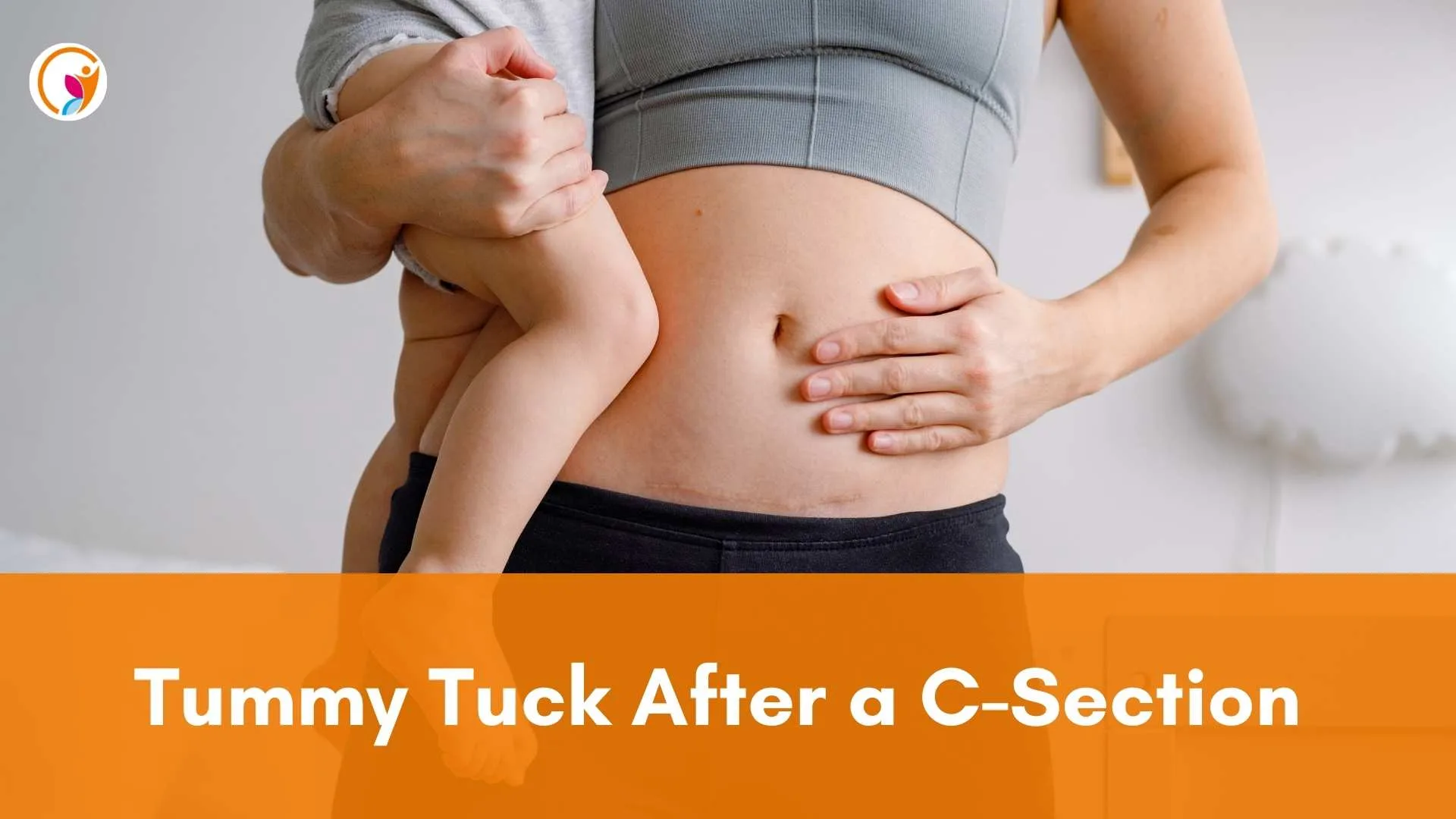 Tummy Tuck After a C-Section