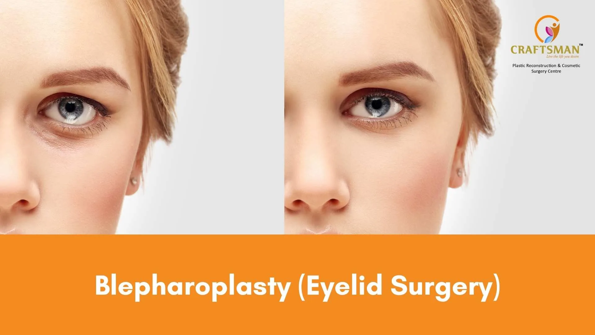 Blepharoplasty (eyelid Surgery)