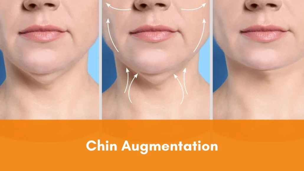 Chin Augmentation