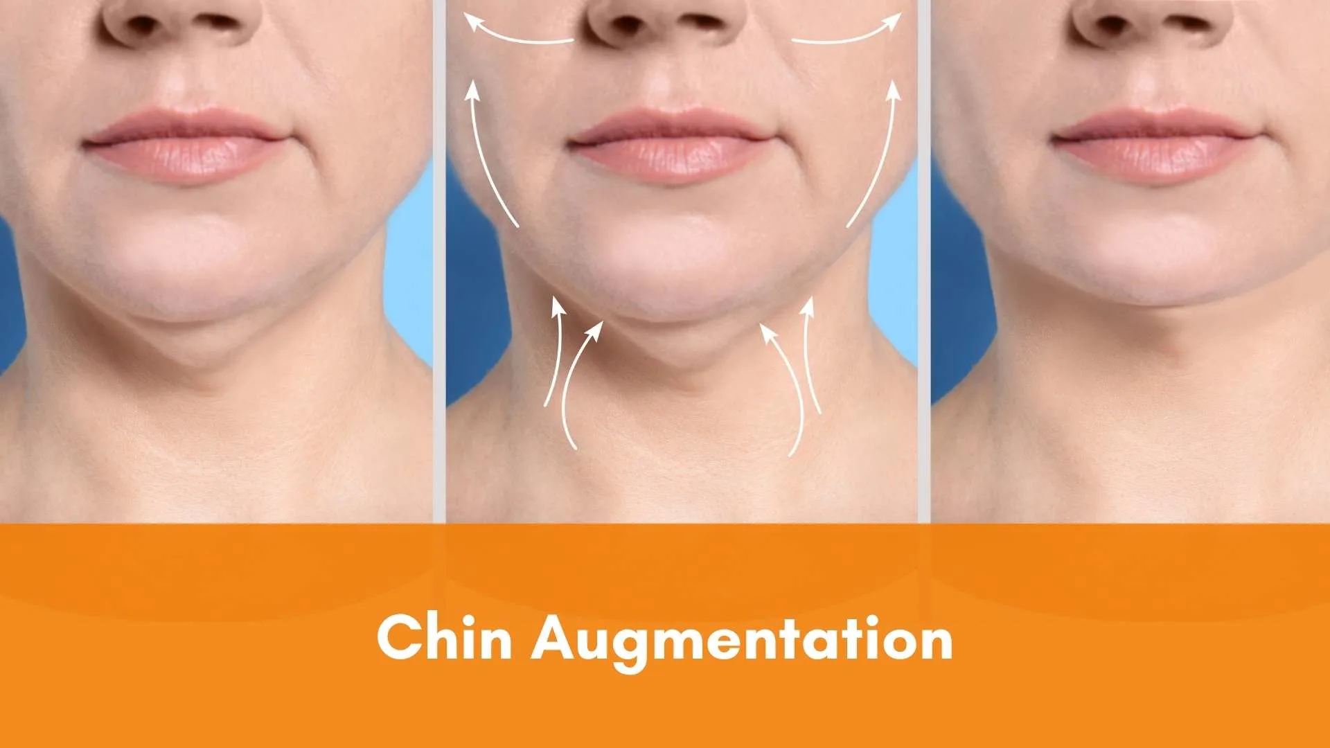 Chin Augmentation