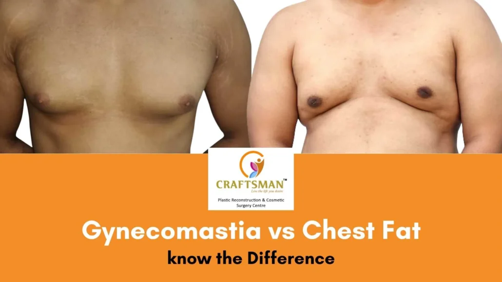 Gynecomastia vs Chest Fat