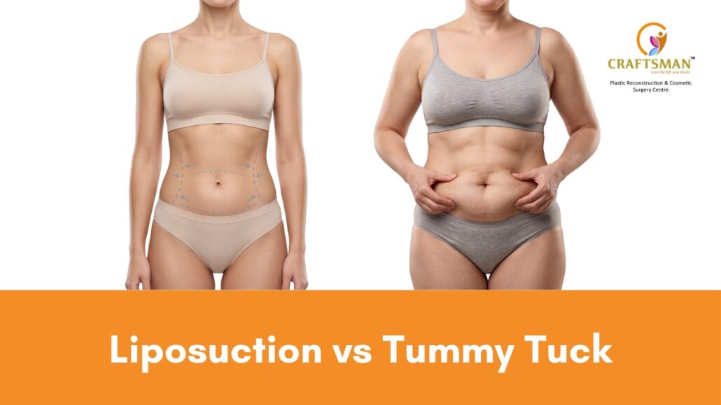 Liposuction vs Tummy Tuck
