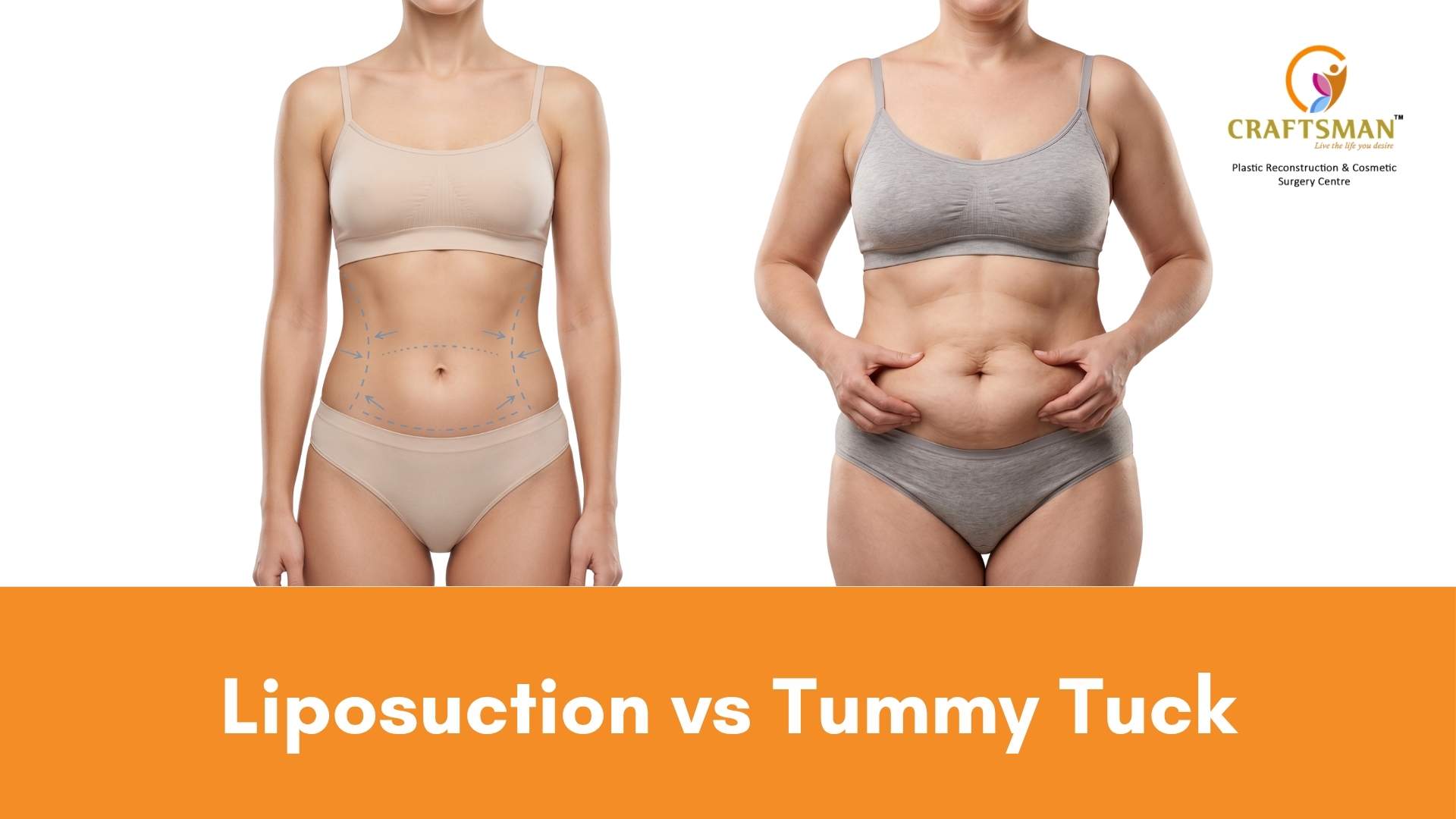 Liposuction vs Tummy Tuck