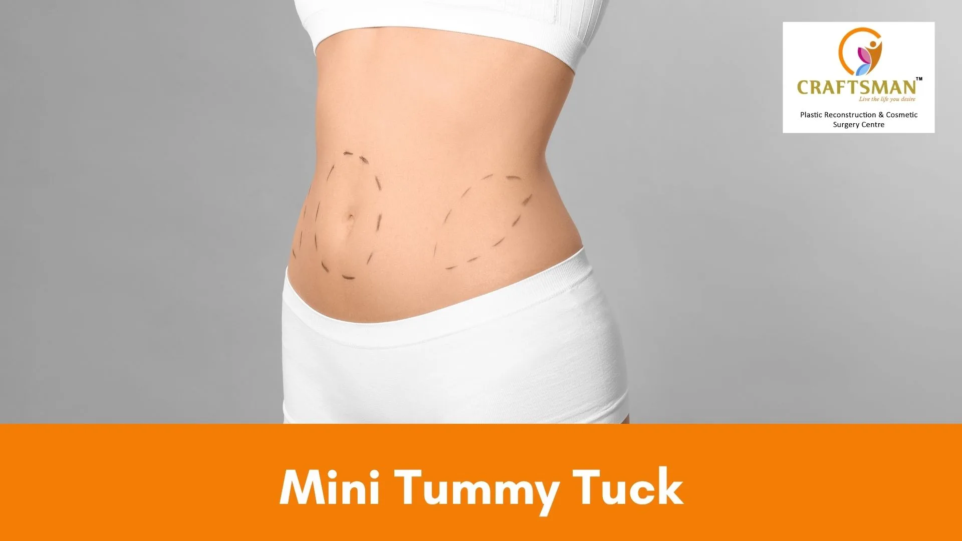 Mini Tummy Tuck